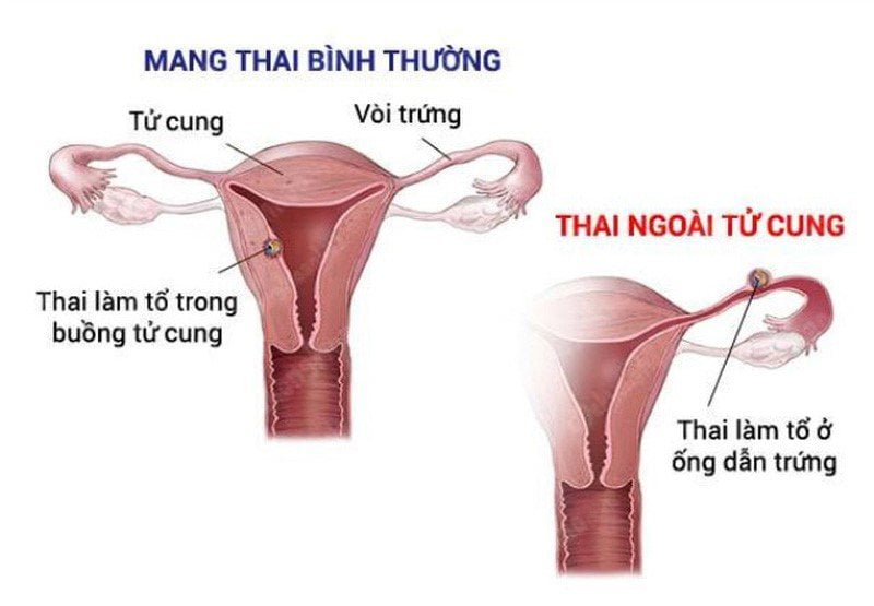 mang-thai-ngoai-tu-cung